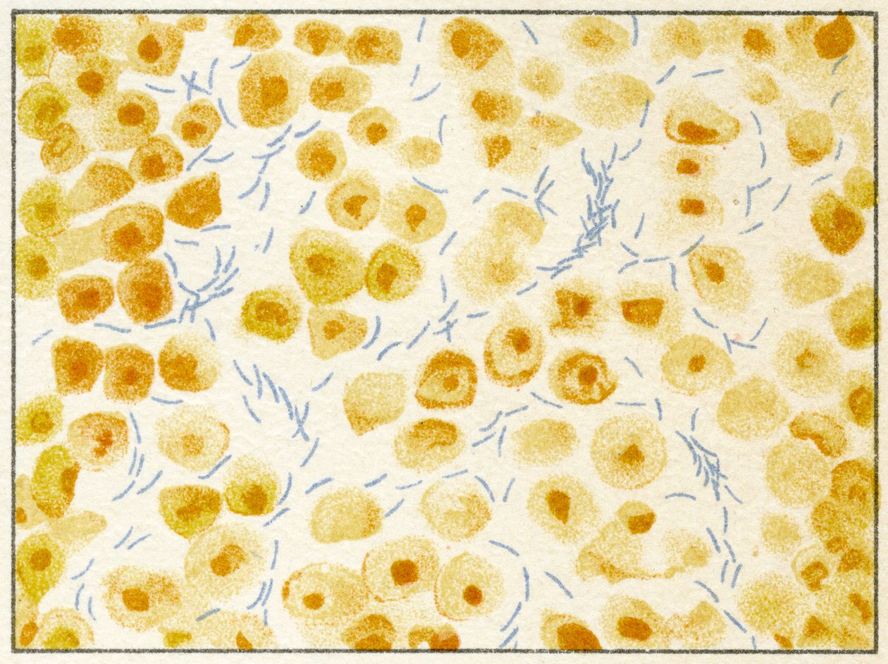Tuberkulosebakterien im Sputum, ca. 1890 von German School