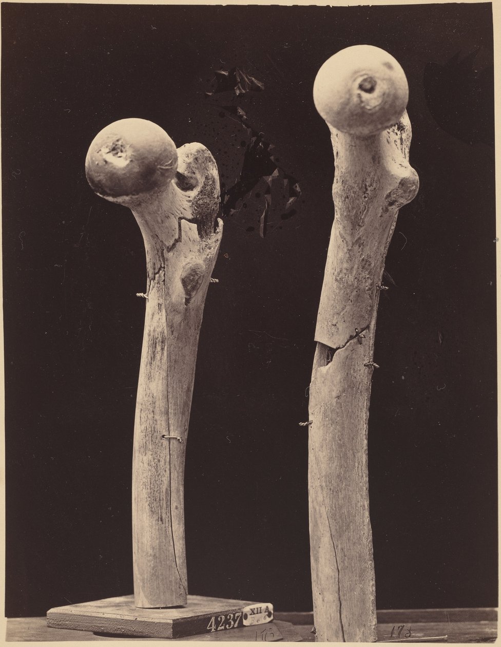 Beispiele von Schussfrakturen des Oberschenkelknochens von American Photographer