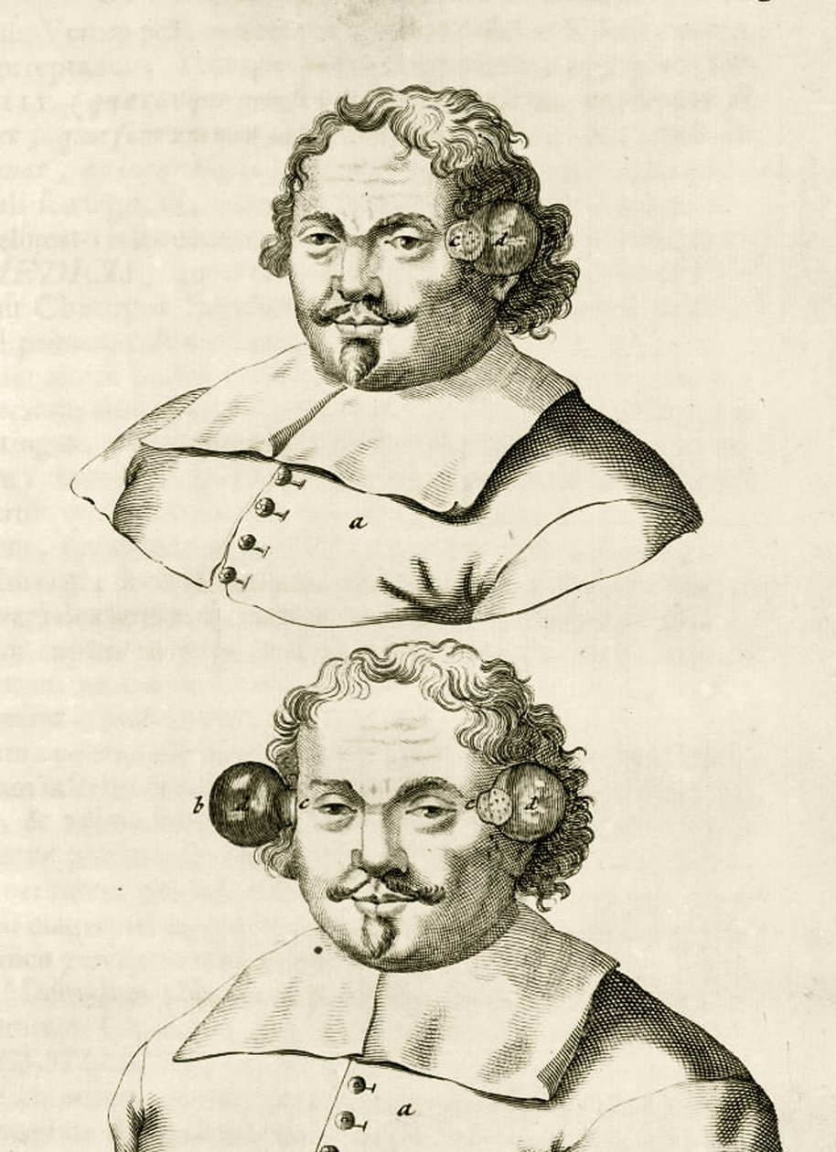 Ein Beispiel für Schröpfen, aus Exercitationes Practicae circa Medendi Methodum von Frederik Dekkers, 1694 von Dutch School