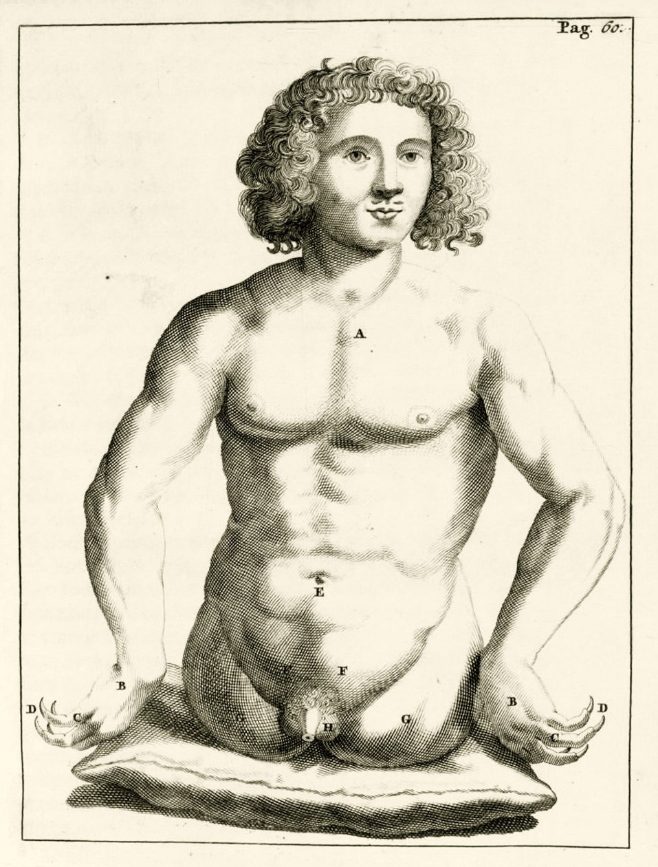 Beispiel für angeborene Geburtsfehler, aus Exercitationes Practicae circa Medendi Methodum von Frederik Dekkers, 1694 von Dutch School