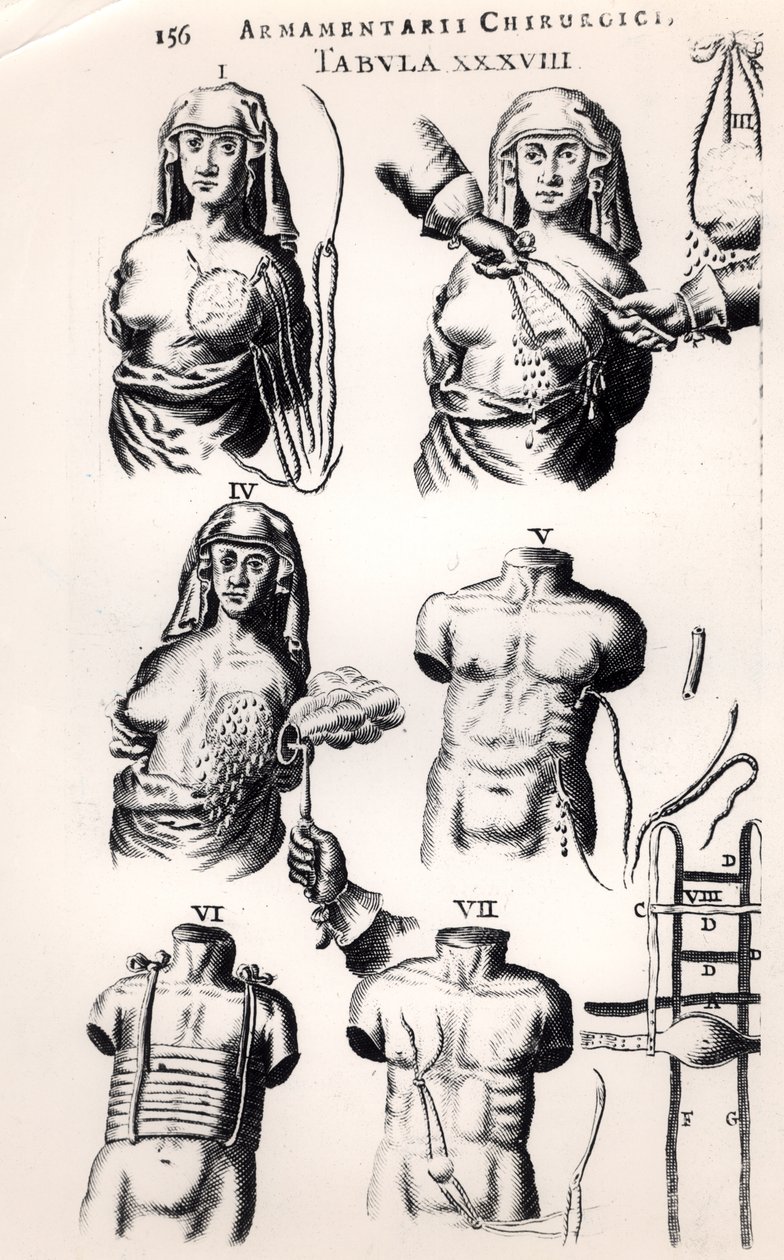 Operation bei Brustkrebs, aus Armamentarii Chirurgici von Johannes Schultes, veröffentlicht in Amsterdam, 1672 von Dutch School