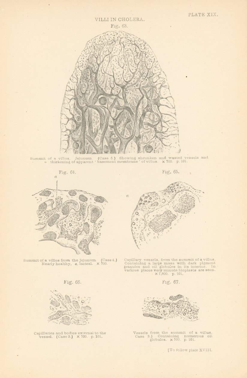 Zotten bei Cholera (Farblithografie) von English School