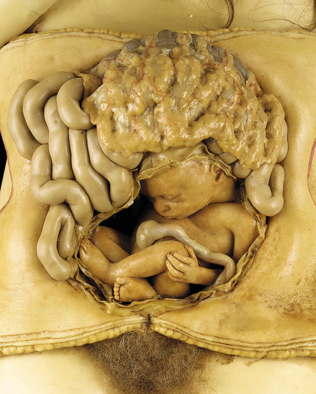 Anatomisches Modell einer Eierstockschwangerschaft (Detail) von European School