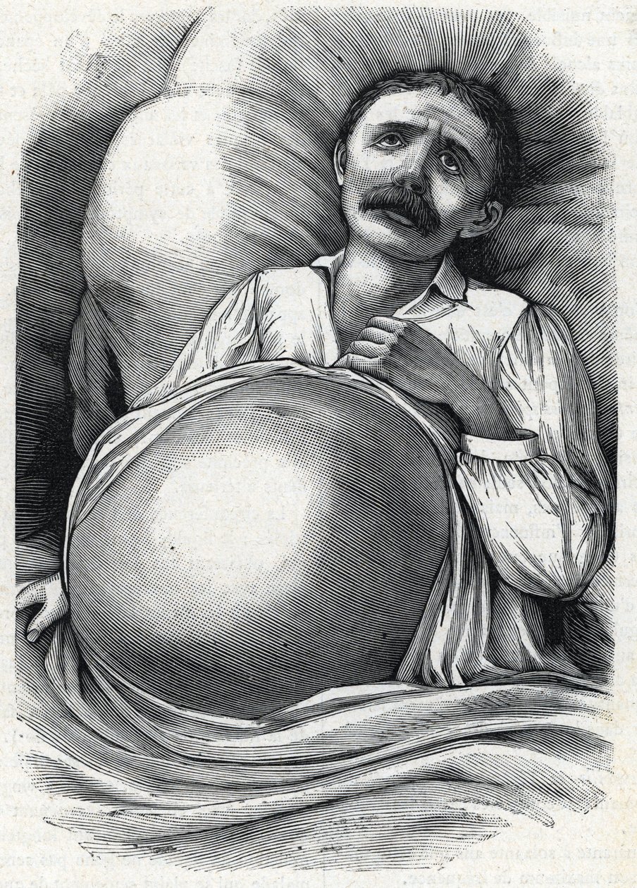 Patient mit fortgeschrittener Leberzirrhose (Gravur) 1888 von French School