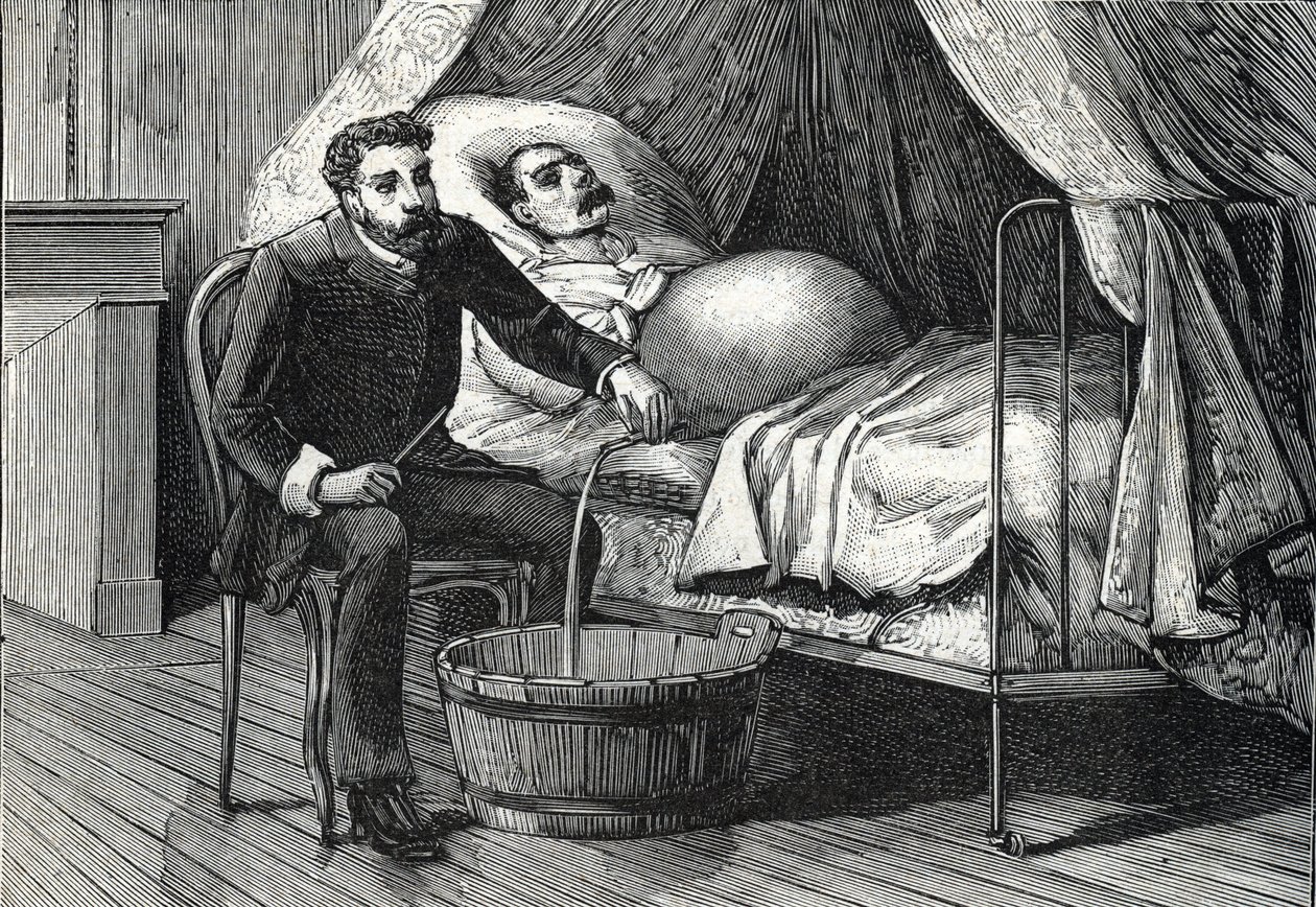 Patient mit fortgeschrittener Leberzirrhose, Arzt führt eine Punktion durch (Gravur) 1888 von French School