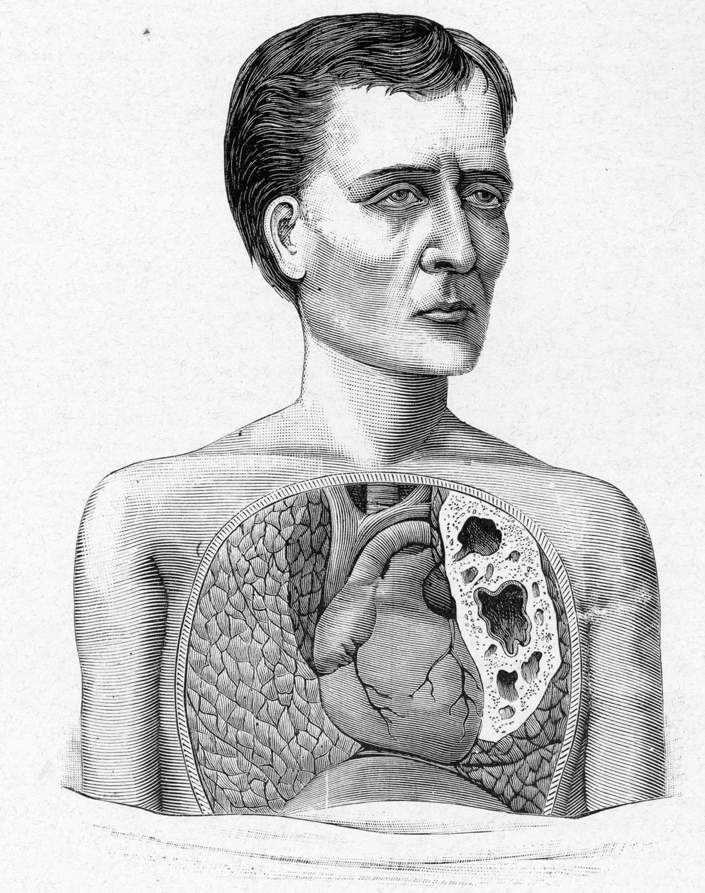Darstellung einer Person mit Höhlen, Komplikation der Tuberkulose (Gravur) von French School