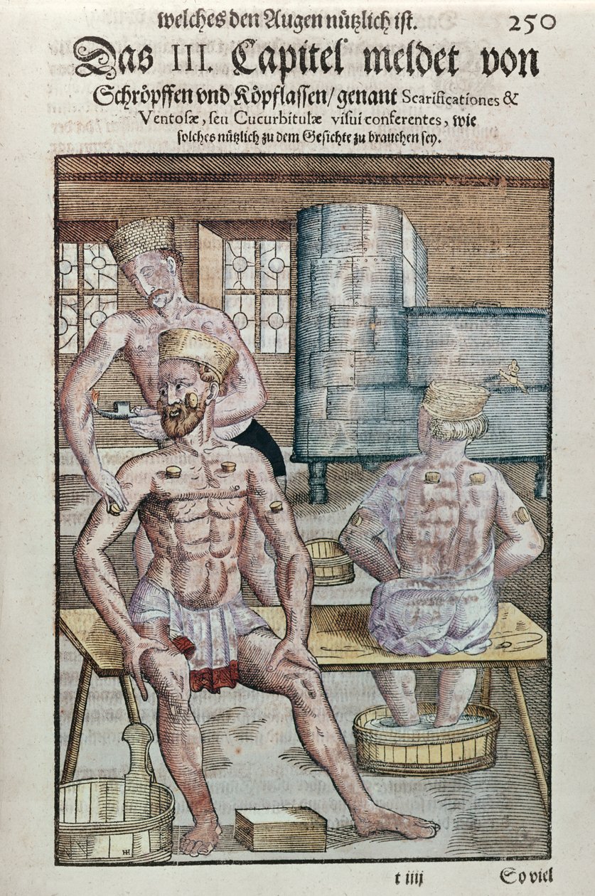 Schröpfen, aus Ophthalmodouleia von Georg Bartisch (1535-1636) veröffentlicht in Dresden 1583 (Farbholzschnitt) von German School