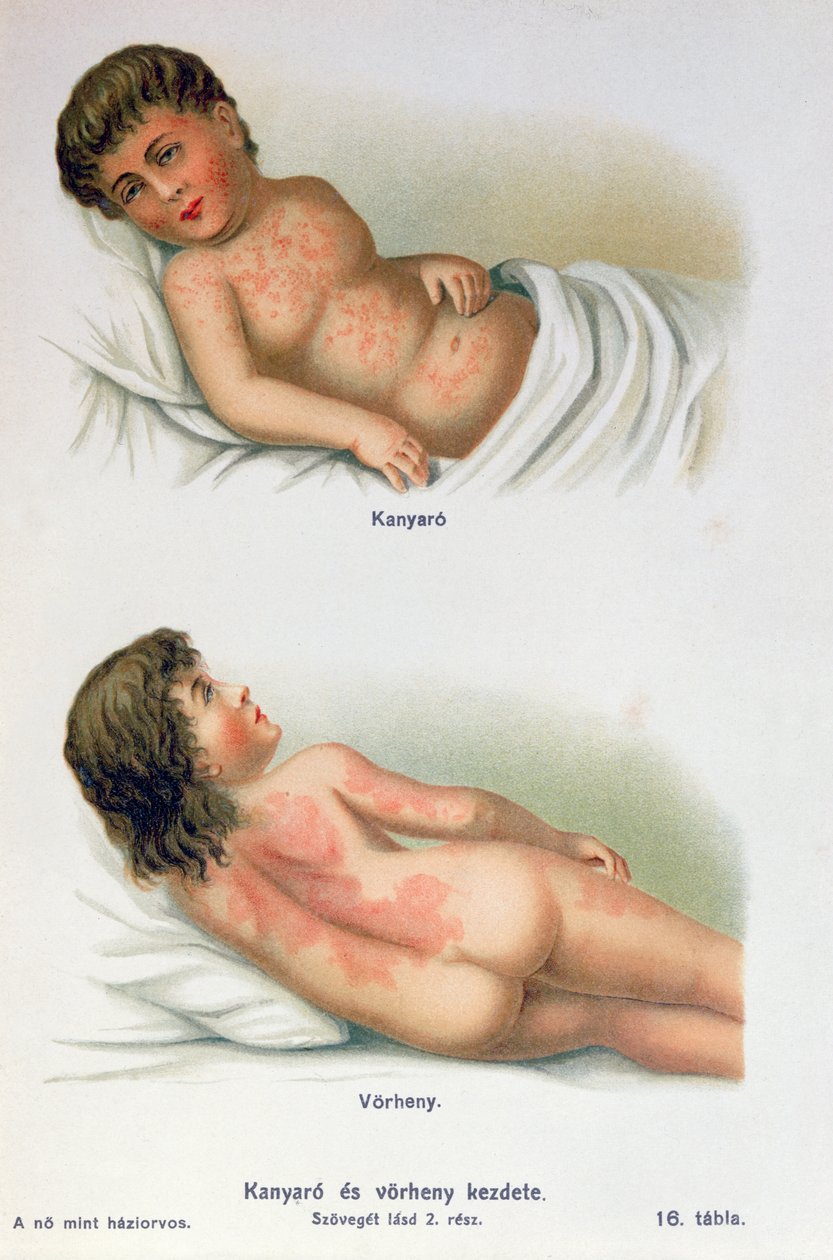Masern und Scharlach, aus einem Familienmedizinbuch, ca. 1900 von Hungarian School