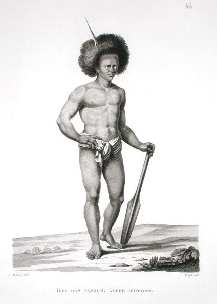 Papua-Inseln: Leprakranker, aus 