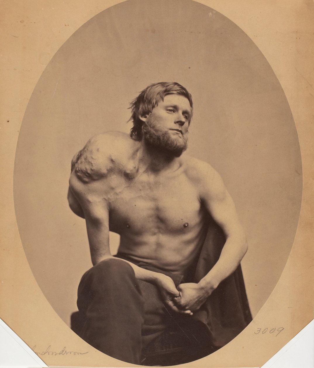 Enchondrom des Schulterblatts von James Wallace Black
