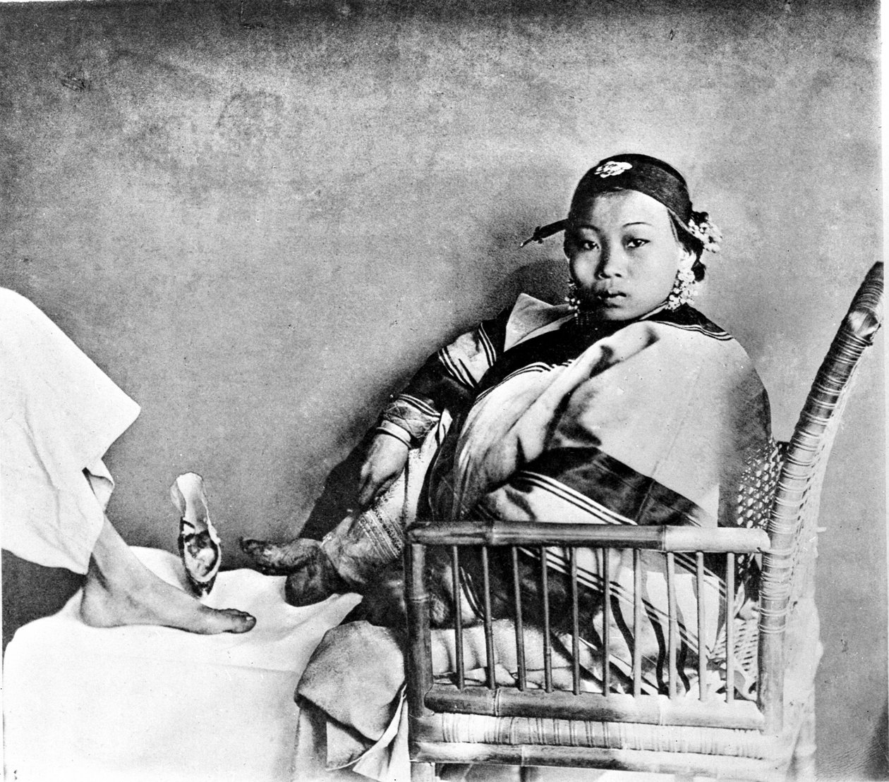 Frau zeigt ihren durch das Tragen traditioneller Schuhe verstümmelten Fuß neben einem europäischen Fuß (Foto) von John Thomson