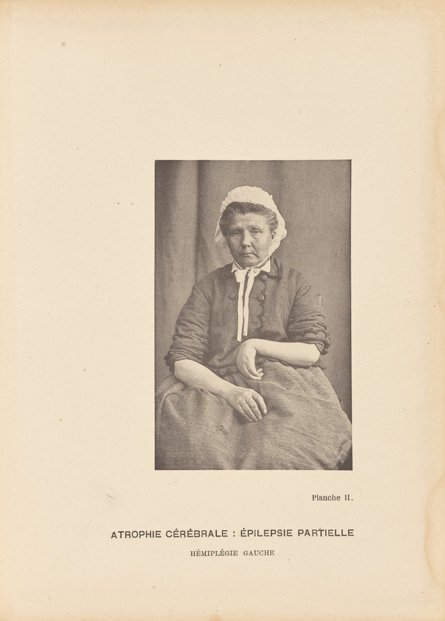 Zerebrale Atrophie: Partielle Epilepsie, linke Hemiplegie von Paul Marie Léon Regnard