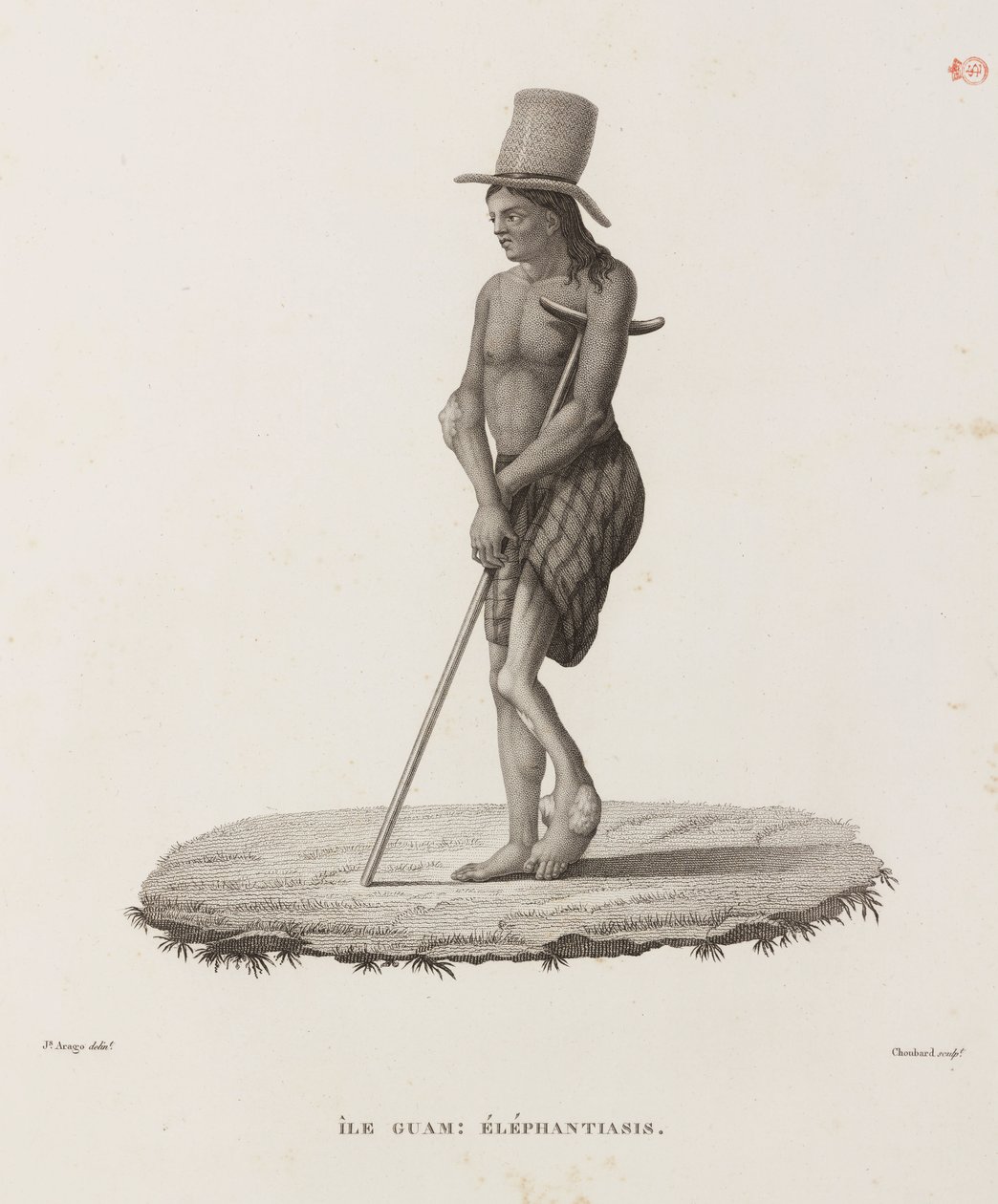Krankheiten, Tropische Krankheiten Mann mit Elephantiasis, Guam von Unbekannt