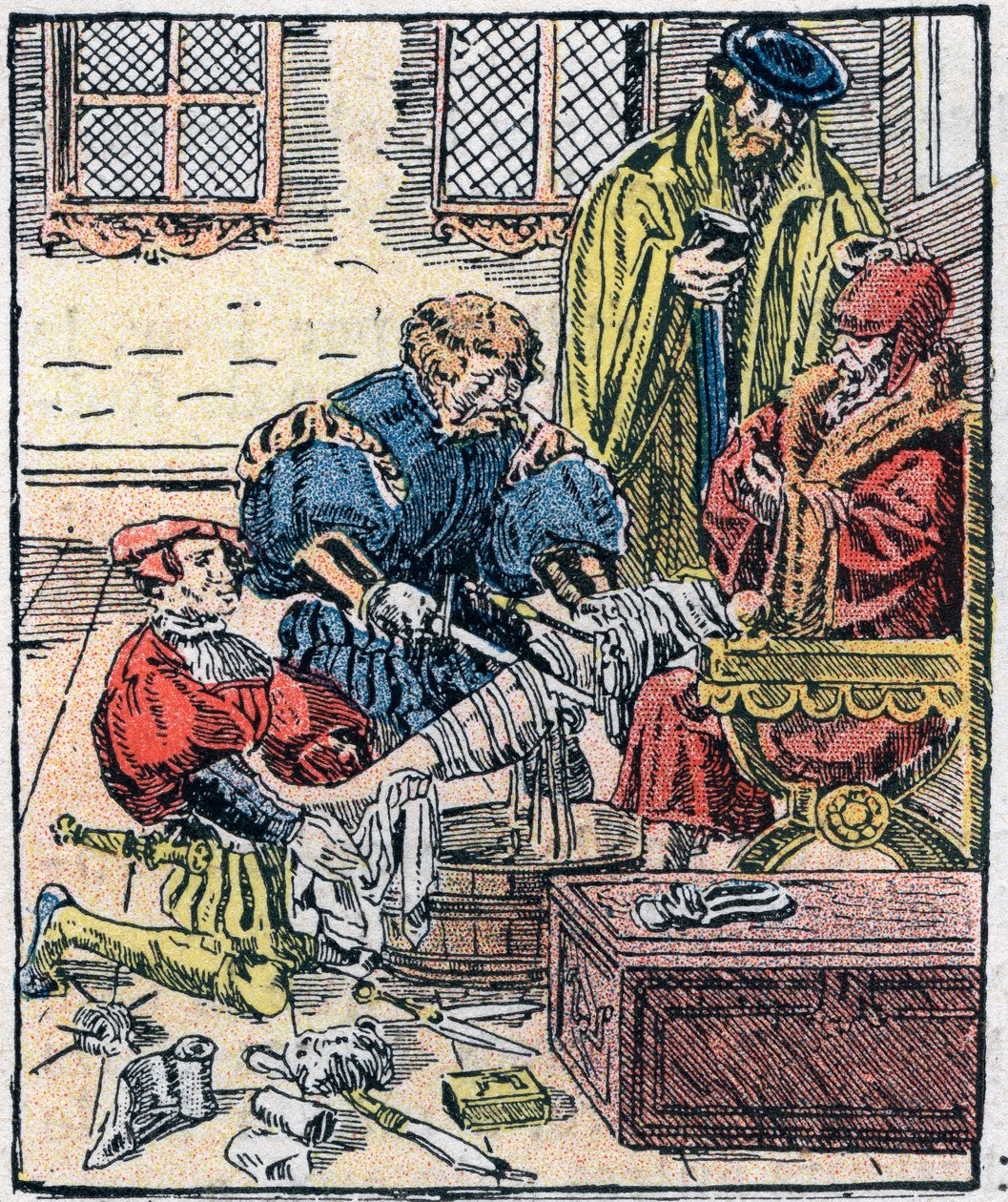 Beinamputation im 16. Jahrhundert von Unknown artist