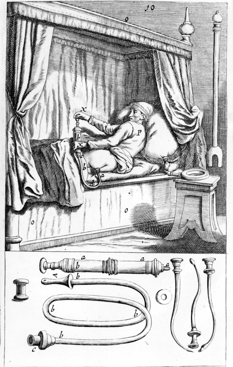 Klistier (für Einläufe) von Johannes Scultetus „Armamentarium Chirurgicum“. Venedig 1665 von Unknown artist