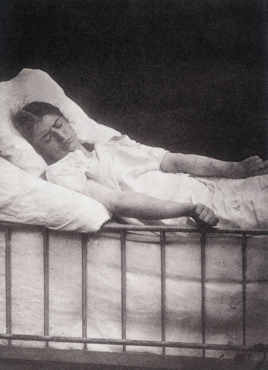 Hystero-Epilepsie - Tetanismus-Anfall in „Photographische Ikonographie der Salpêtrière: Dienst von Herrn Charcot“ von Paul Regnard und Bourneville von Unknown artist