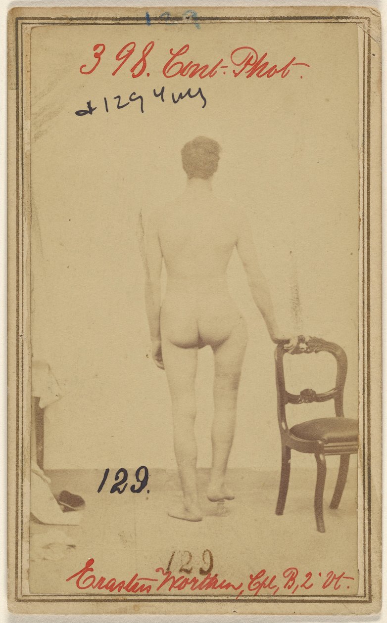 Bruch des oberen Drittels des Oberschenkelknochens. Erastus Worthen, Corp Co. B. 2. Vermont Vols. Alter 25 - Wohnort Stockbridge VT. von Unknown artist