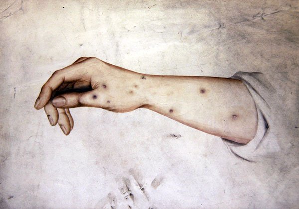 Studie eines Unterarms mit Hauterkrankung, ca. 1850 von William Lover