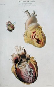 Tafel, die Herzkrankheiten darstellt. Spontaner Herzriss einer 86-jährigen Frau (Abb. 1) und Perikarditis bei einem sechs Tage alten Baby (Abb. 2), aus 