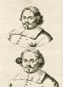 Ein Beispiel für Schröpfen, aus Exercitationes Practicae circa Medendi Methodum von Frederik Dekkers, 1694 von Dutch School