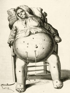 Abfluss von Flüssigkeit aus einem Abszess, aus Exercitationes Practicae circa Medendi Methodum von Frederik Dekkers, 1694 von Dutch School
