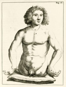 Beispiel für angeborene Geburtsfehler, aus Exercitationes Practicae circa Medendi Methodum von Frederik Dekkers, 1694 von Dutch School