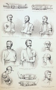 Vorübergehende Behandlung von Frakturen, um 1890 von English School
