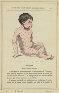Aussehen und Verteilung der Masernflecken zu Beginn des Ausbruchs