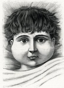 Kind mit Mumps (Gravur) 1888 von French School