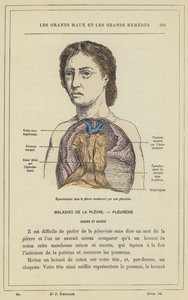 Erguss in die Pleura verursacht durch eine Pleuritis
