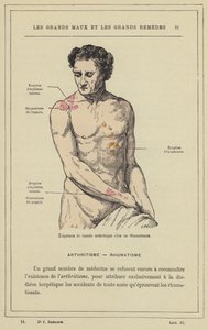 Arthritische Eruptionen bei einem Rheumatiker