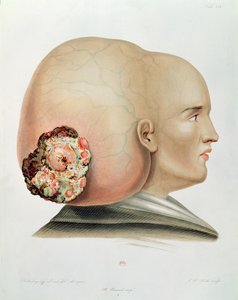 Pilz des Dura Mater, aus Selecta Praxis Medico-Chirurgica von Alexander Auvert, Paris, 1856 von French School