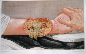 Krankenhausbrandwunde, aus 