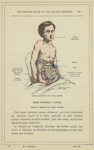 Charakteristische Läsionen des Typhus