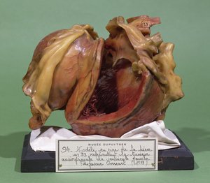 Modell eines Tumors des linken Ventrikels, 1799