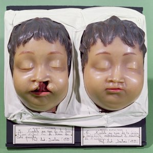 Modell, das ein Kinder Gesicht vor und nach einer Operation zur Korrektur einer Hasenscharte zeigt, durchgeführt von Antoine Dubois (1756-1837) im Jahr 1799 (Wachs)
