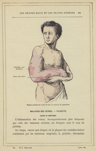 Tiefe Phlebitis der Armvenen in der Eiterungsphase