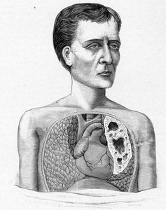 Darstellung einer Person mit Höhlen, Komplikation der Tuberkulose (Gravur)