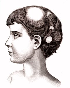 Ringelflechte bei einem Kind. 1887 (Gravur) von French School