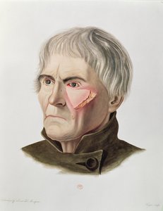Hauttransplantationsoperation, aus Selecta Praxis Medico-Chirurgica von Alexander Auvert, Paris, 1856 von French School