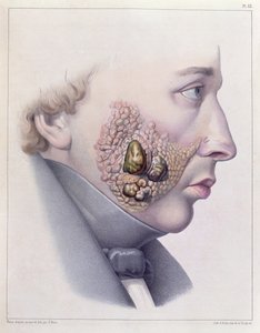 Die Gesichtssymptome der Geschlechtskrankheit, aus Traité Complet des Maladies Vénériennes von Philippe Ricord (1800-89) 1851 von French School