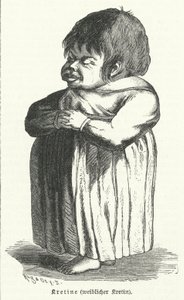 Kretin, Frau mit angeborenem Jodmangelsyndrom (Gravur)