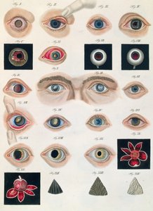 Beschreibung angeborener Augenanomalien, aus Klinische Darstellungen der Krankheiten und Bildungsfehler des menschlichen Auges, von Friedrich August von Ammon (1799-1861) 1838 von German School