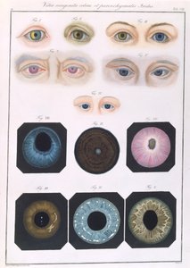 Beschreibung angeborener Augenanomalien, aus Klinische Darstellungen der Krankheiten und Bildungsfehler des menschlichen Auges, von Friedrich August von Ammon (1799-1861) 1838 von German School