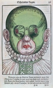 Maske zur Behandlung eines Strabismus, aus Ophthalmodouleia von Georg Bartisch (1535-1636) veröffentlicht in Dresden 1583 (Farbholzschnitt)