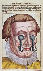 Behandlung einer Augenkrankheit, aus Ophthalmodouleia von Georg Bartisch (1535-1636) veröffentlicht in Dresden 1583 (Farbholzschnitt) von German School