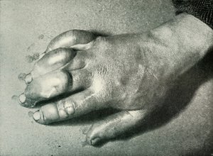 Dr. Atkinsons erfrorene Hand, 5. Juli 1911