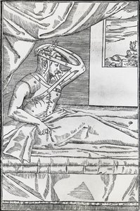 Rhinoplastik-Operation, bei der die Nase des Patienten an eine Hautklappe am Oberarm angeschlossen wurde von Italian School