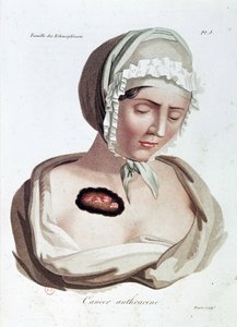 Anthrazin-Krebs - Alibert, B.N.