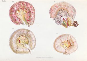 Die äußere Oberfläche der mit Cholera infizierten Eingeweide, aus Anatomie Pathologique du Cholera Morbus, von Nikolai Ivanovich Pirogov (1810-81) veröffentlicht in St. Petersburg, 1849